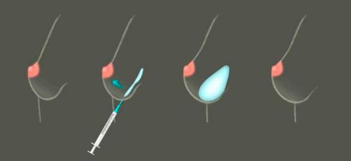 Borstvergroting met behulp van op hyaluronaat gebaseerde injecties