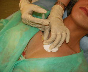 Introductie van mesococktail in borstweefsel - een alternatief voor injecties met hyaluronzuur