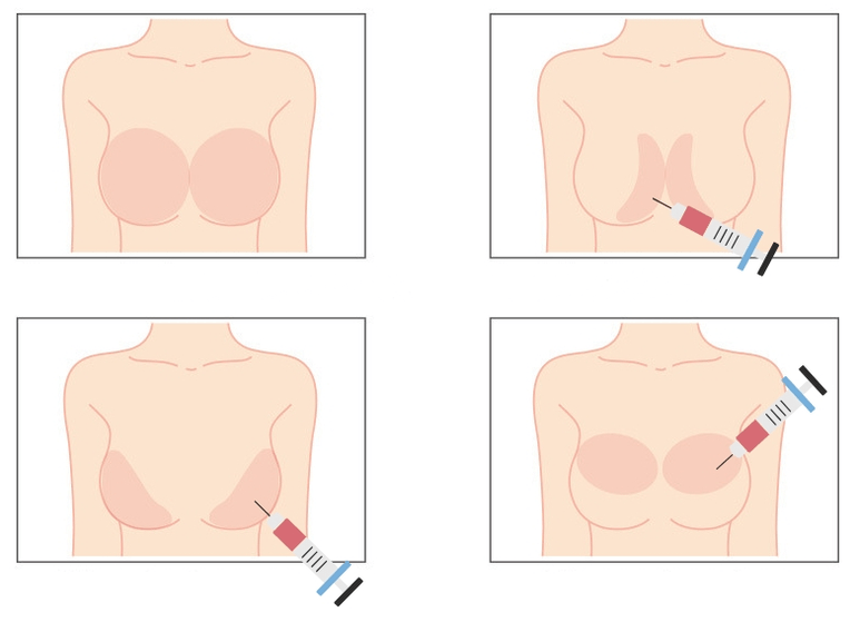 Plaatsen voor injectie van hyaluronzuur in de borst