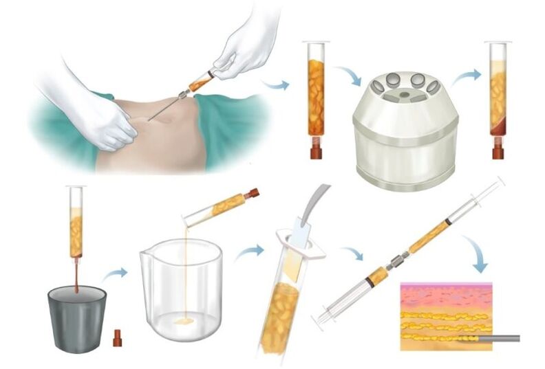 Verwijdering van vet uit probleemgebieden, verwerking en injectie in borstweefsel