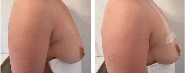 Voor en na draad borstlift