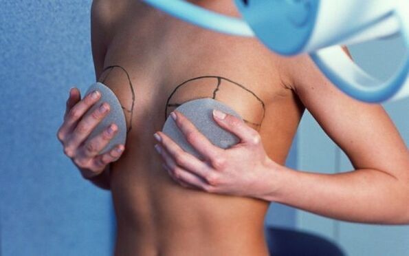 borstvergroting met implantaten