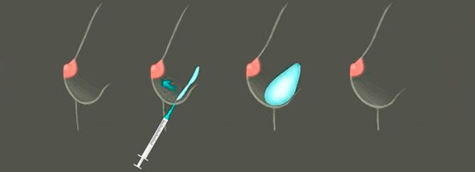 De procedure voor het injecteren van hyaluronzuur in de borst