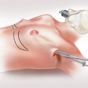 Endoscopische borstvergroting